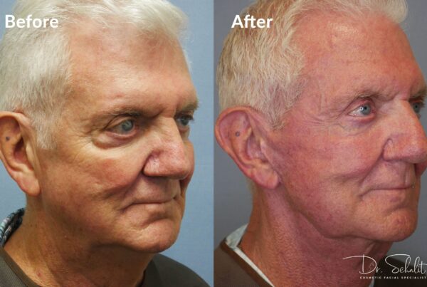 a man's face before and after a facelift in Daytona Beach with Dr. Schalit.
