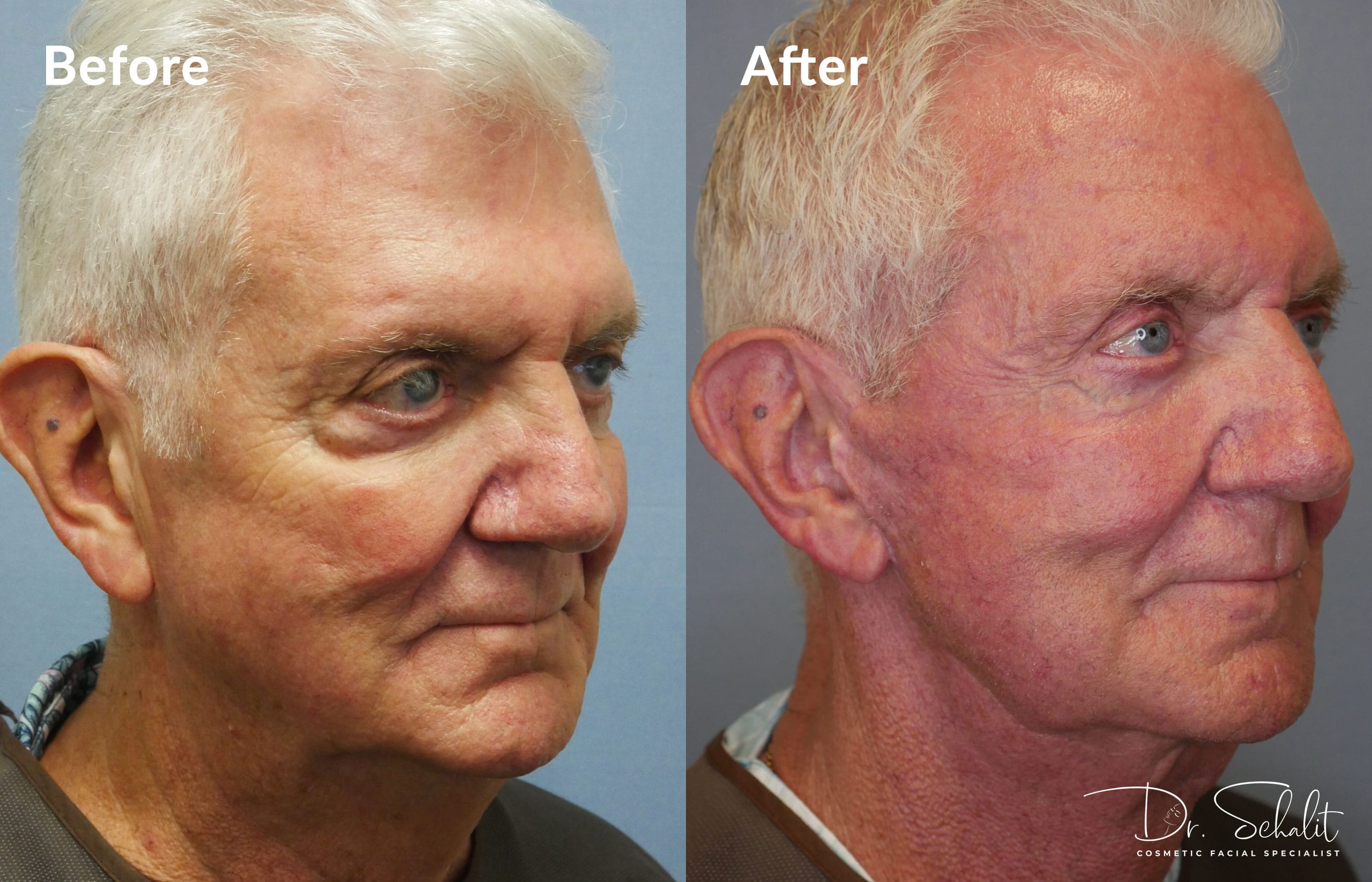 a man's face before and after a facelift in Daytona Beach with Dr. Schalit.
