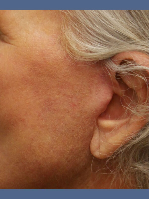 What-to-Expect-After-Surgery-scar-1