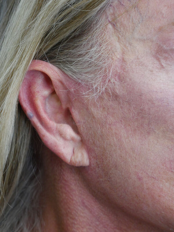 What-to-Expect-After-Surgery-scar-3