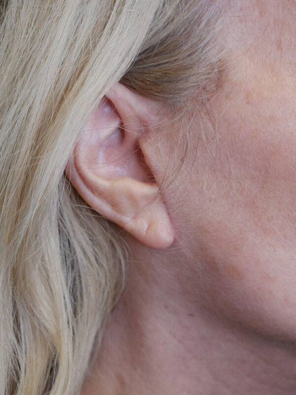 What-to-Expect-After-Surgery-scar-5