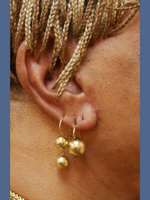 What-to-Expect-After-Surgery-scar-6