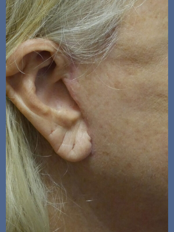 What-to-Expect-After-Surgery-scar-7