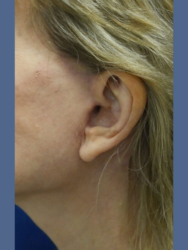 What-to-Expect-After-Surgery-scar-8